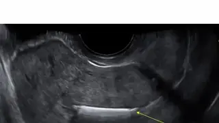 ARDMS Ultrasound Flashcards Lt screenshot