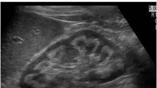 ARDMS Ultrasound Flashcards Lt screenshot