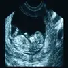 ARDMS Ultrasound Flashcards Lt