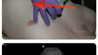 POC Ultrasound Guide screenshot