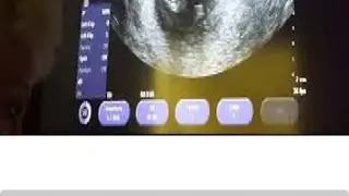 Ultrasound Video screenshot